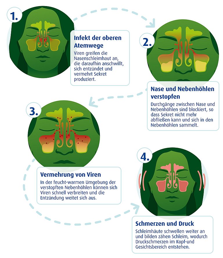 Aus einer Erkältung mit Schnupfen kann sich eine hartnäckige Sinusitis entwickeln Infografik, die die Entstehung einer Sinusitis kurz erklärt.