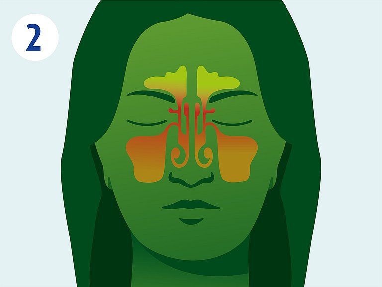 Infografik über Schwellung der Nasennebenhöhlen.