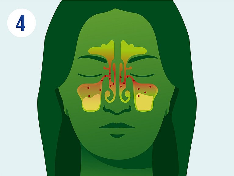 Infografik über Vermehrung der Viren bei Nasennebenhöhlenentzündung.