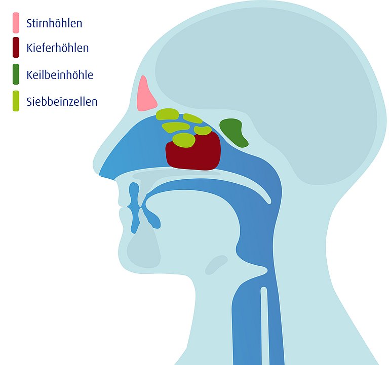 Vier verschiedene Paare von Nasennebenhöhle sind mit der Nasenhöhle verbunden Grafik eines menschlichen Schädels mit den vier Nasennebenhöhlen