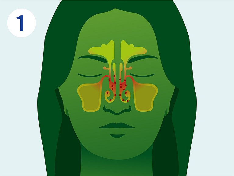 Infografik über den Verlauf einer Nasennebenhöhlenentzündung.