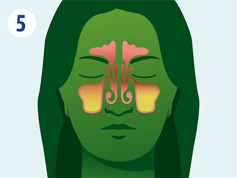 Infografik über Ausweitung der Entzündung der Nasennebenhöhlen.