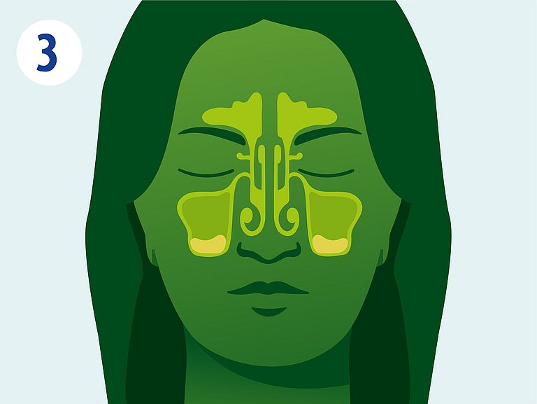 Infografik über Sekretstau in den Nasennebenhöhlen.